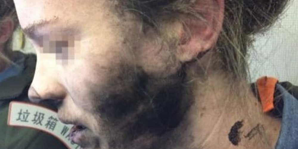 Mulher australiana com o rosto queimado por explosão dos seus headphones Beats