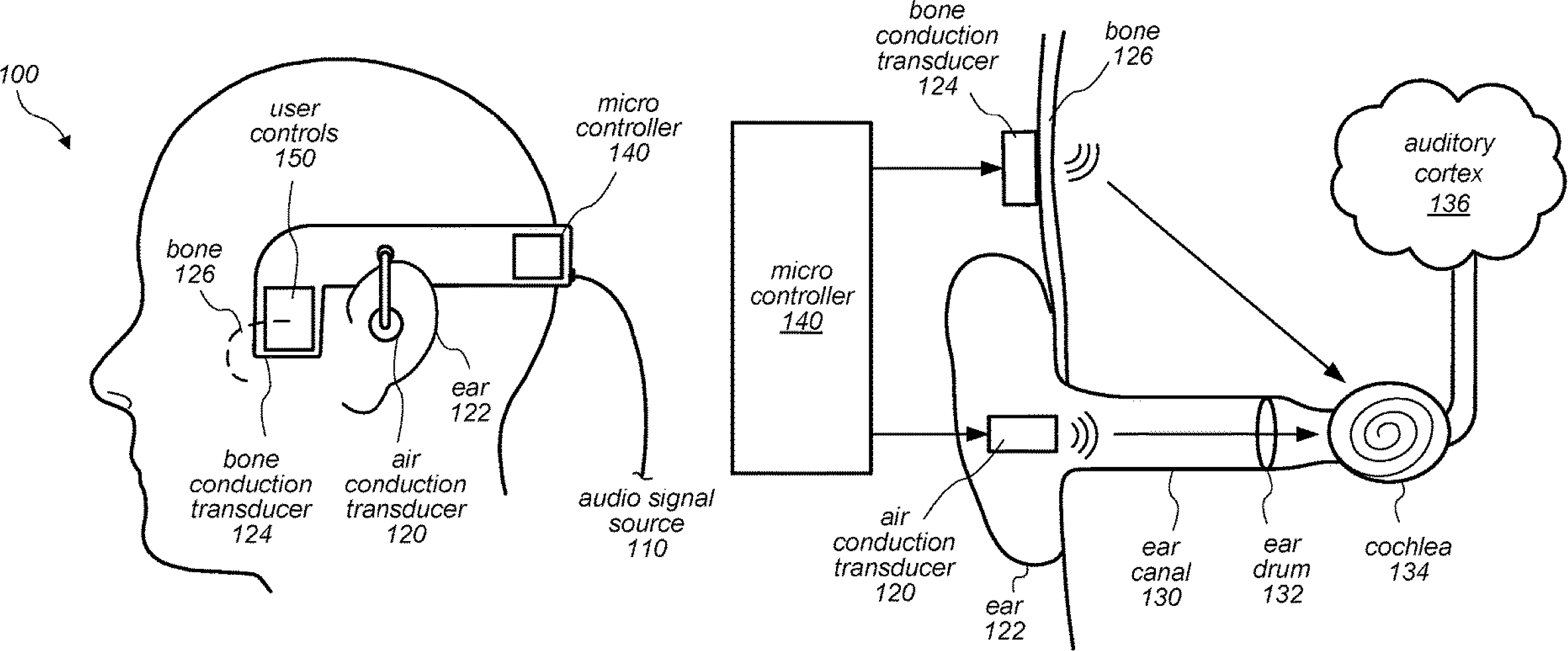Patente que cobre transmissão de áudio por condução óssea