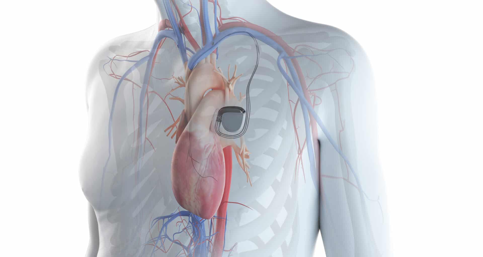 Gráfico 3D de coração com marcapasso