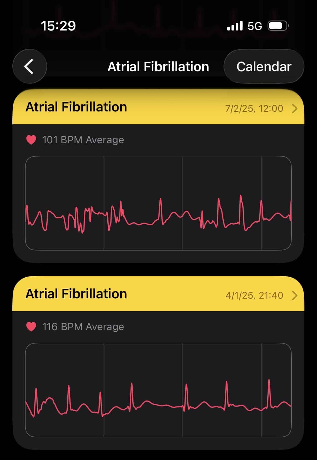 Fibrilação Atrial